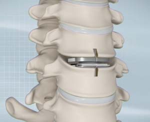 Artificial Cervical Disk Replacement