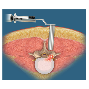 Lumbar Endoscopic Discectomy