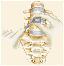 Anterior Lumbar Interbody Fusion, Southfield Michigan