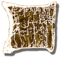 Vertebral Compression Fractures, Sugar Land TX