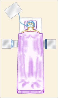 Anterior Lumbar Interbody Fusion (ALIF), Southfield Michigan