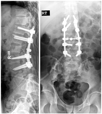 Tumors & Trauma Fractures Michigan | Vertebral Compression Fracture