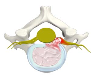 Cervical Herniated Disk