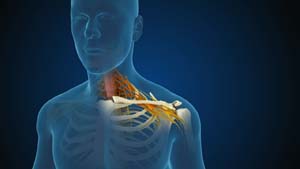 Cervical Radiculopathy