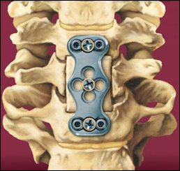 Cervical Corpectomy and Strut Graft