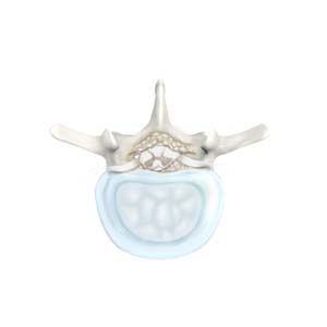 Lumbar Stenosis