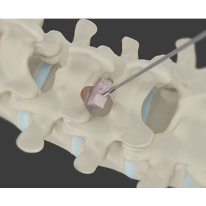 Lumbar Discectomy