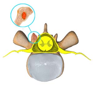 Spinal Tumor