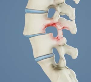 Degenerative Disc Disease (DDD)