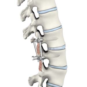 Transforaminal Lumbar Interbody Fusion (TLIF)