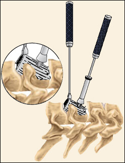 Cervical Corpectomy, Southfield Michigan
