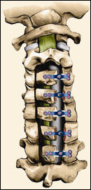 Cervical Laminoplasty, Houston TX