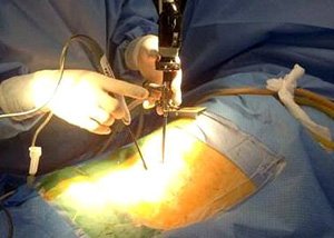 Lumbar Endoscopic Discectomy