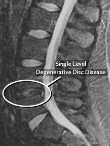 Degenerative Disc Disease, Sugar Land TX