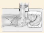 Incision for Spine Surgery, Southfield Michigan