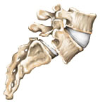 Spondylolisthesis, Sugar Land TX