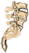 Spondylolisthesis Type III, Houston TX